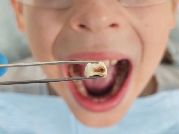 Best Emergency Treatment for Dental Infections or Abscesses in Millbrook, AL